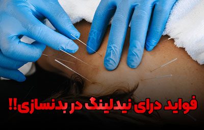 dry-needling درای نیدلینگ چیست؟